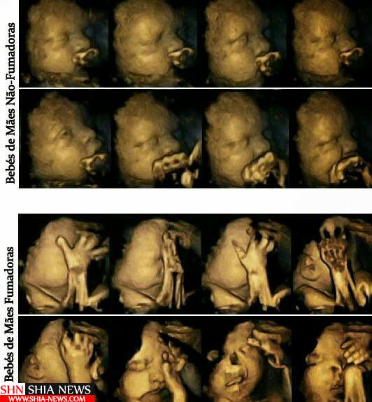 تصاویر تکان دهنده از اثر سیگار بر جنین