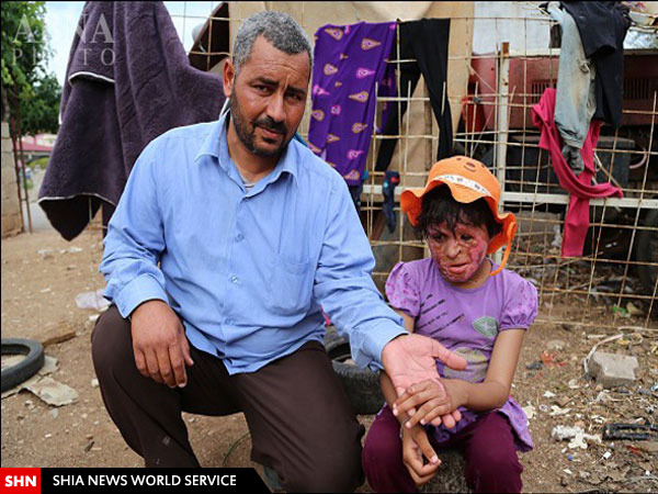چهره سوختۀ دختر 8 ساله سوری(18+)