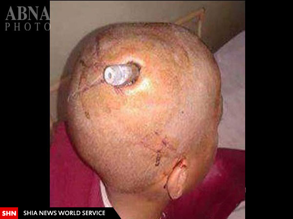 اصابت گلوله به سر یک کودک افغان + تصاویر