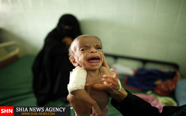 تصاویر دلخراش از کودکان قحطی زده یمن