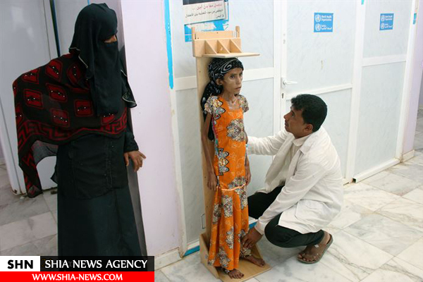 فاطمه دختر ۱۲ ساله یمنی با ۱۰ کیلو وزن!