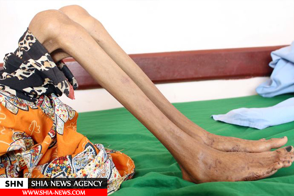 فاطمه دختر ۱۲ ساله یمنی با ۱۰ کیلو وزن!