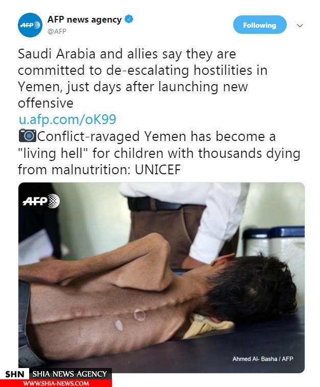 عکس تکان‌دهنده خبرگزاری فرانسه از یک کودک یمنی