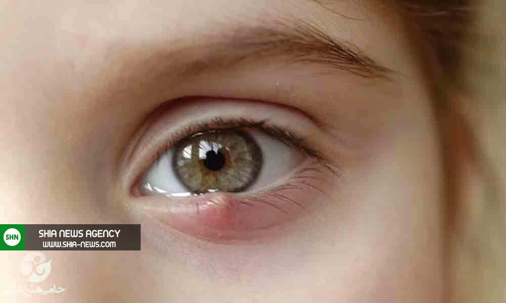 چگونه چشم درد را در خانه درمان کنیم؟