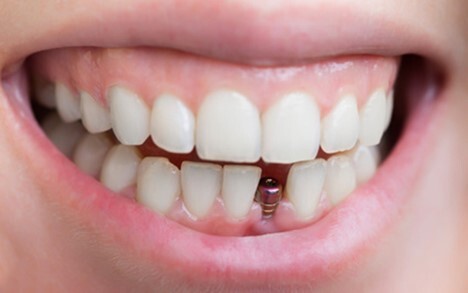 مینی ایمپلنت دندان با ایمپلنت معمولی چه تفاوتی دارد؟