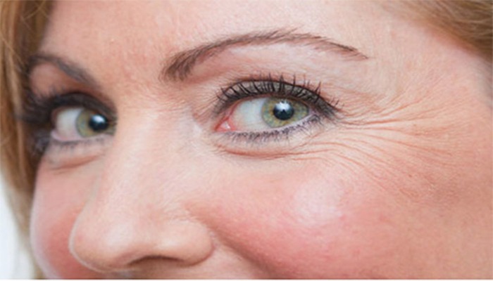 7 روش موثر برای رفع سریع چروک دور چشم