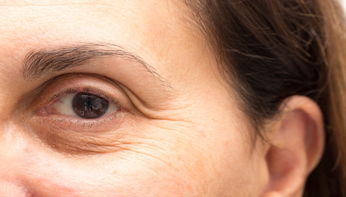 7 روش موثر برای رفع سریع چروک دور چشم