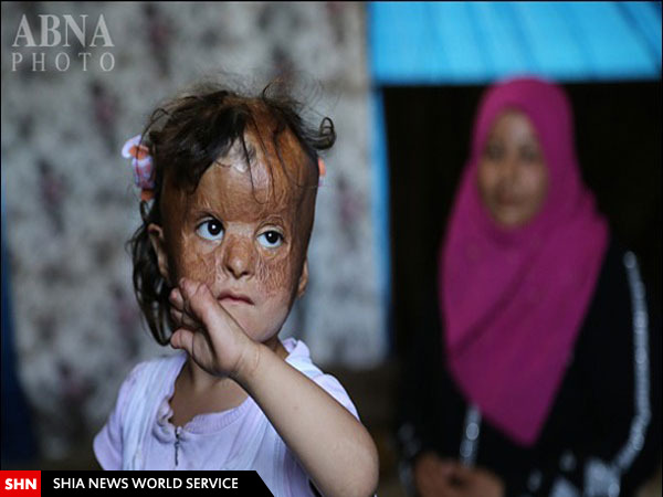 سوختگی شدید «فاطمه حسین علی» دختر سه ساله سوری/ تصاویر