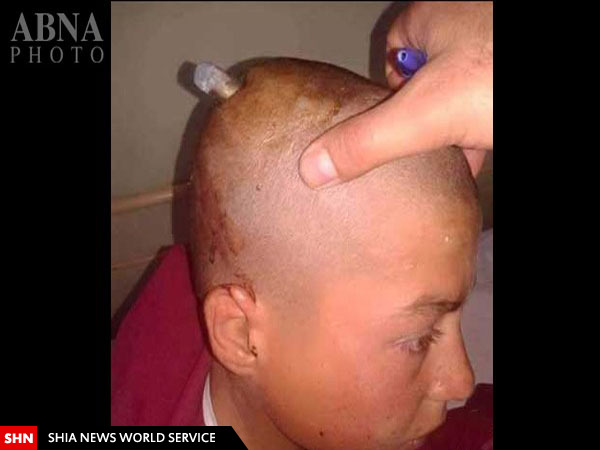 اصابت گلوله به سر یک کودک افغان + تصاویر