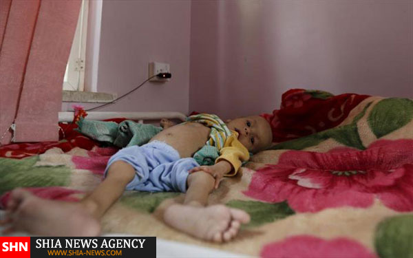 تصاویر دلخراش از کودکان قحطی زده یمن