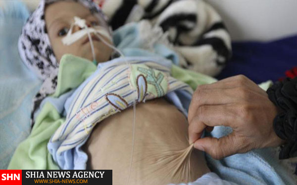 تصاویر دلخراش از کودکان قحطی زده یمن