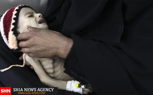 تصاویر دلخراش از کودکان قحطی زده یمن