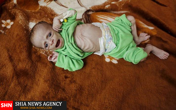 تصاویر دلخراش از کودکان قحطی زده یمن