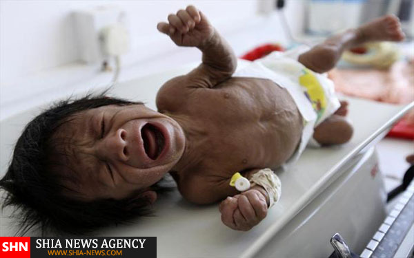 تصاویر دلخراش از کودکان قحطی زده یمن