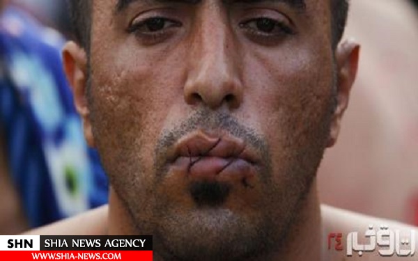 دوختن دهان 4 عراقی با نخ فلزی +تصویر
