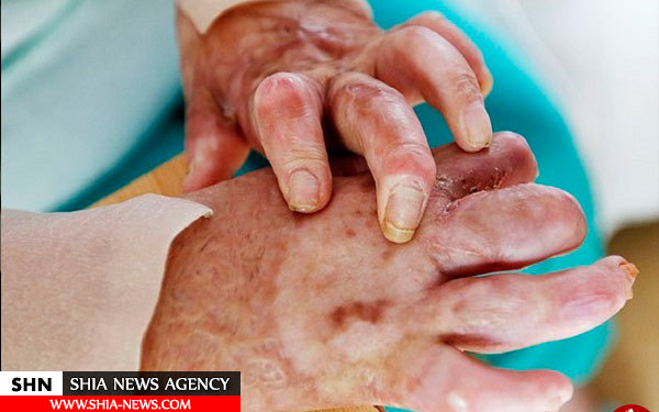 خودسوزی دختر نوجوان ایزدی + تصاویر