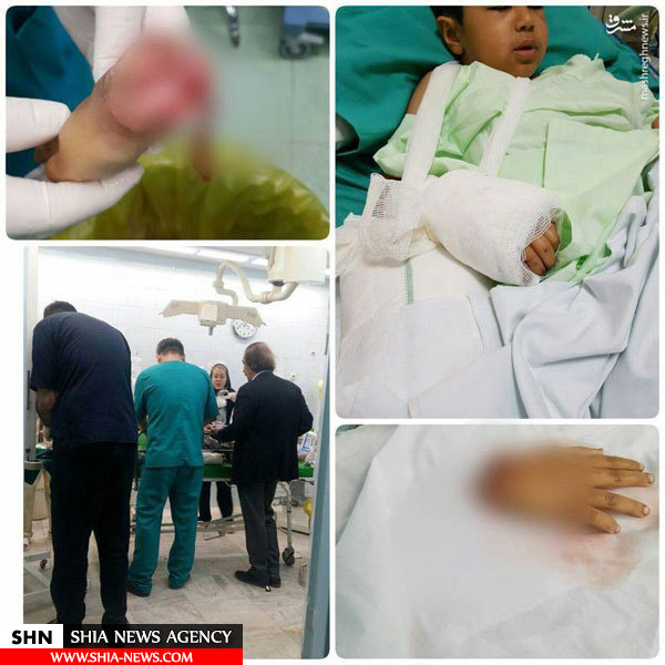 تصویر پیوند دست قطع شده کودک زلزلهزده تصویر پیوند دست قطع شده کودک زلزلهزده