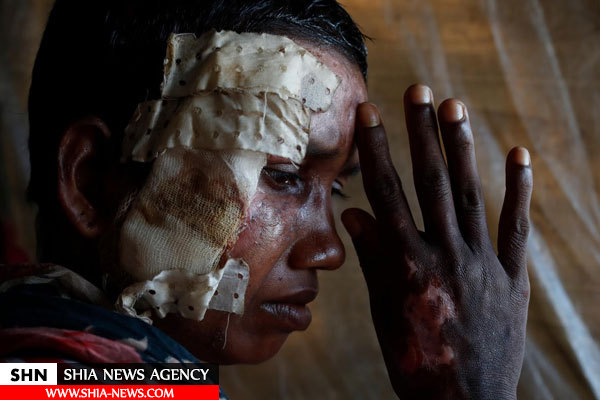 تصاویر بهت‌آور رویترز از آثار گلوله و سوختگی روی تن غیرنظامیان روهینگیا