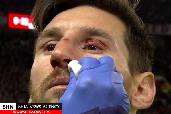 مصدومیت خونین مسی مقابل منچستریونایتد+ تصاویر