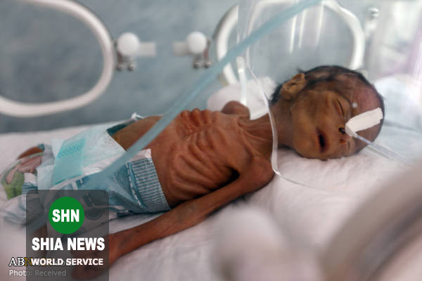 سوءتغذیه وحشتناک نوزاد یمنی
