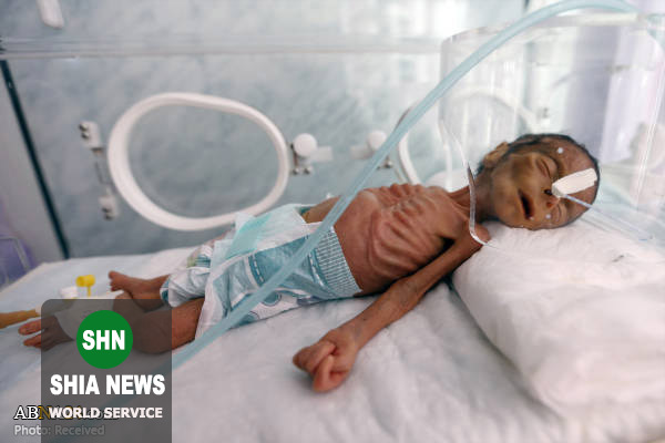 سوءتغذیه وحشتناک نوزاد یمنی