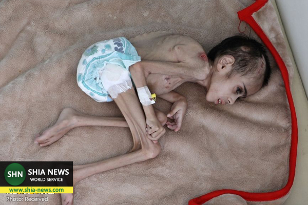 سوءتغذیه وحشتناک کودک یمنی