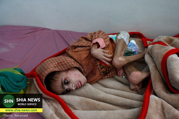سوءتغذیه وحشتناک کودک یمنی