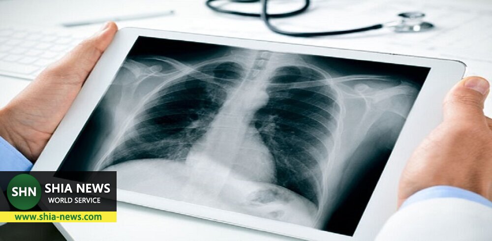 علائم انواع عفونت های ریوی در کودکان و بزرگسالان