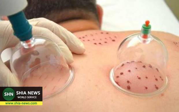 بادکش درمانی چیست؟