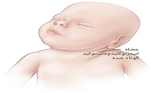 کجی گردن کودکان را جدی بگیرید کجی گردن کودکان را جدی بگیرید