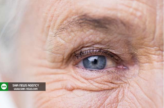 درمان پیر چشمی با لیزر