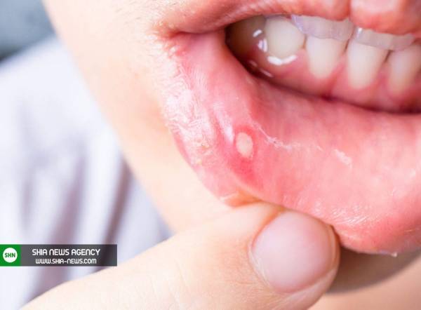 درمان فوری آفت دهان با چند برگ ریحان
