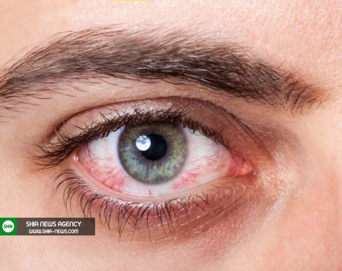 ترشحات چشمی که نیاز به درمان دارند