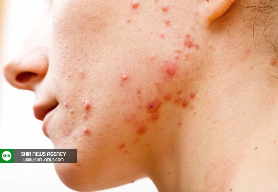 تکنیک های درمانی جوش بعد از اصلاح صورت