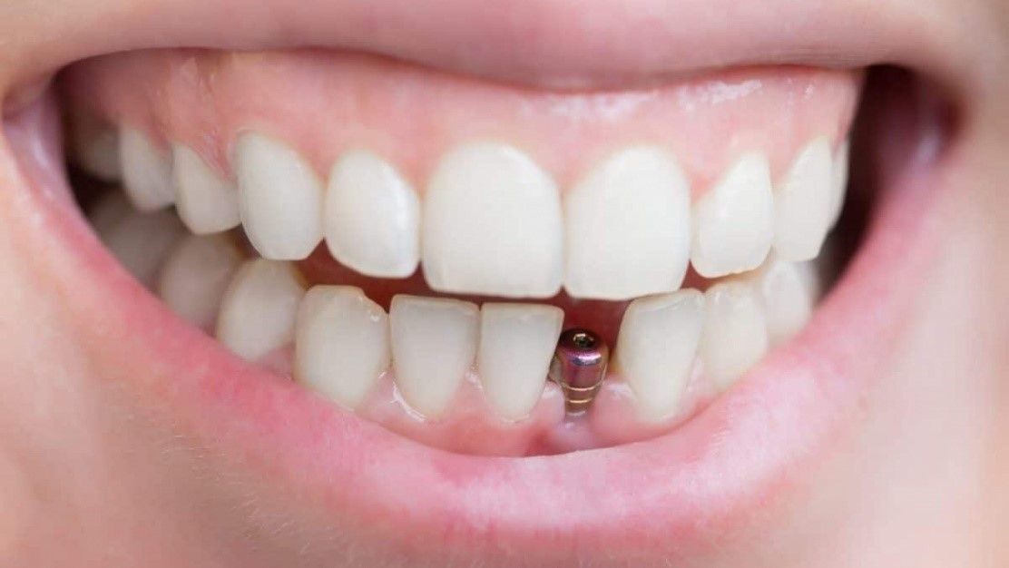 ایمپلنت دندان در سریتا؛ بهترین راه حل برای دندان از دست رفته