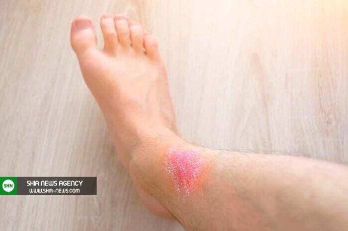 بررسی و شناخت علل لکه های قرمز روی پا