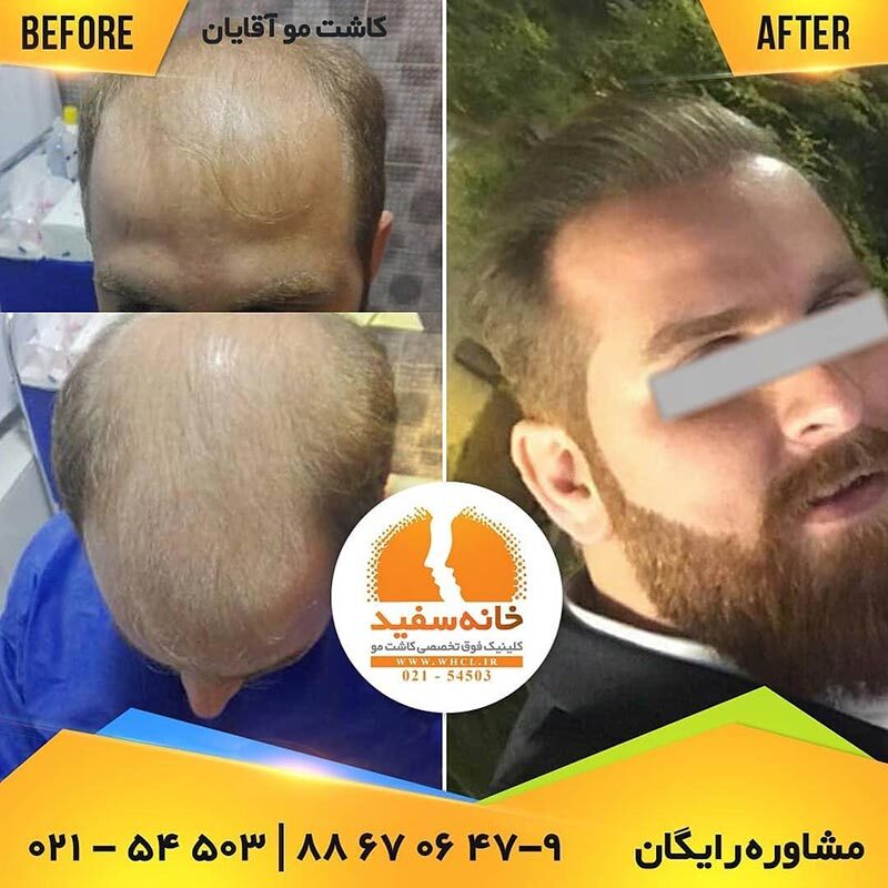 آشنایی به بهترین روش های کاشت مو در ایران آشنایی به بهترین روش های کاشت مو در ایران