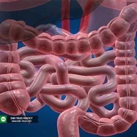 انسداد روده بزرگ، علائم، علت&zwnj;ها و درمان