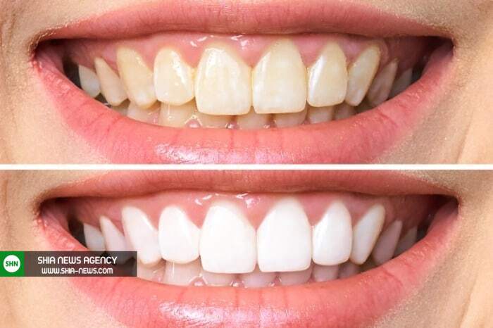 14 راه فوری و طبیعی “سفید کردن دندان ها” به روش خانگی