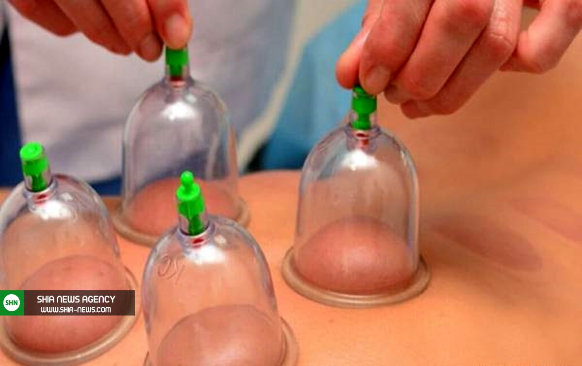 همه چیز درباره حجامت + 8 نکته خواندنی