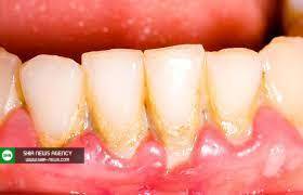چگونه می ‎توان از تشکیل پلاک دندان پیشگیری کرد؟