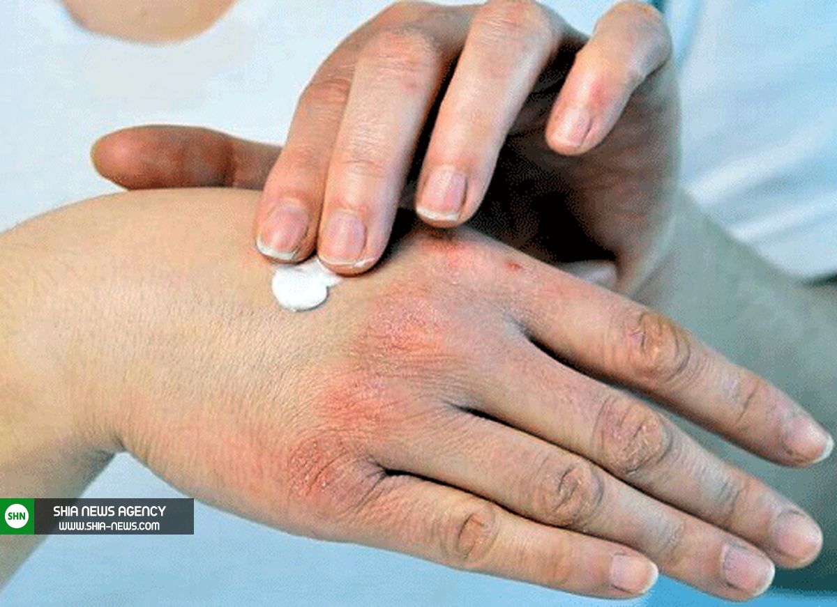بهترین توصیهها برای بهبود خشکی پوست بهترین توصیهها برای بهبود خشکی پوست