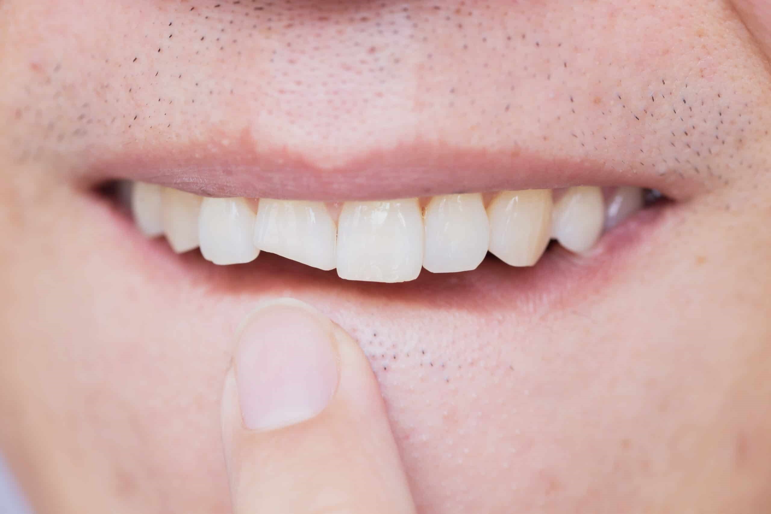 درمان ترک و شکستگی دندان: جلوگیری از تخریب بیشتر دندان