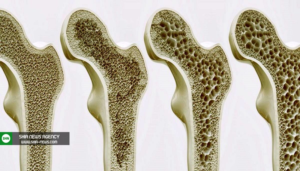 پوکی استخوان یا استئوپروز چیست؟ + پیشگیری و درمان