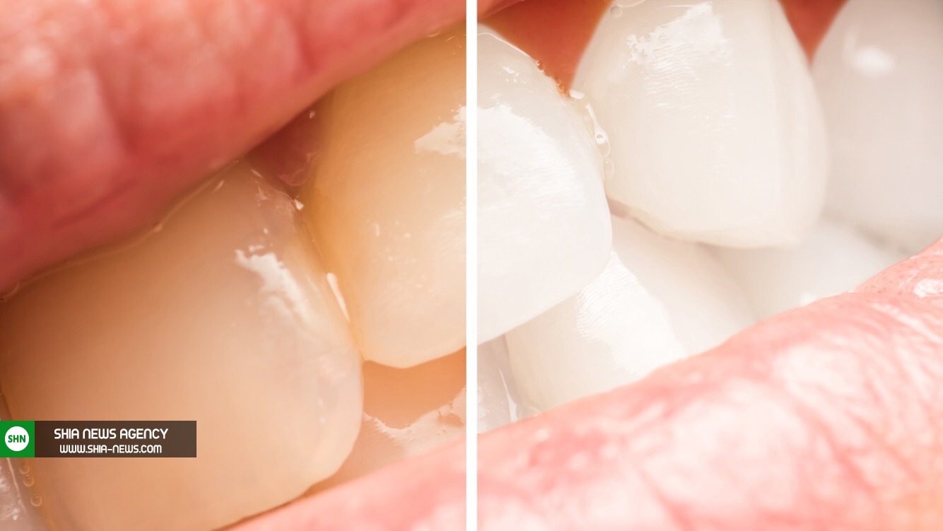ترکیب سفید کننده طبیعی برای دندان‌های‌تان