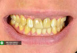 علت زردی دندان ها چیست؟