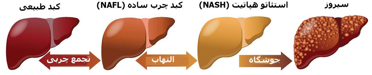 آیا کبد چرب قابل‌درمان است؟