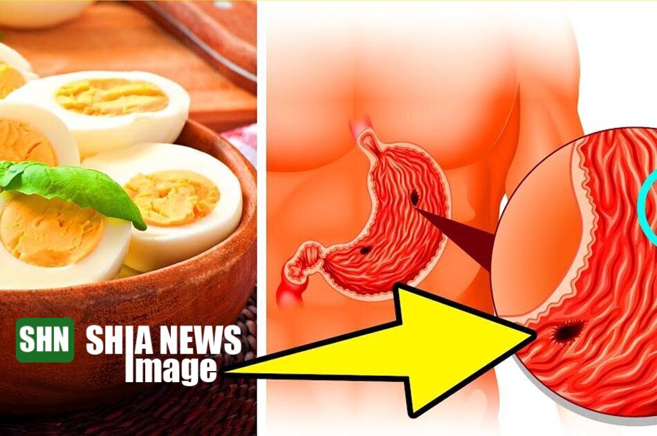 برای زخم معده چه غذاهایی بخوریم؟