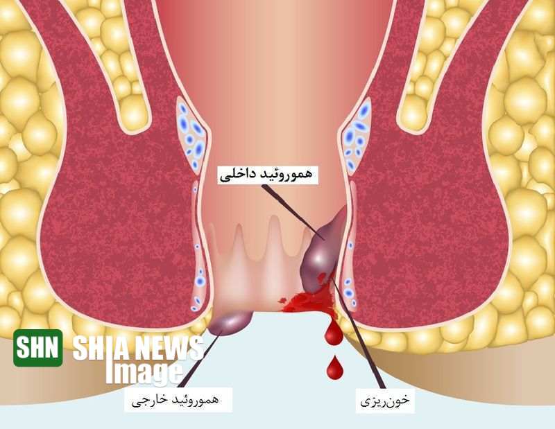 علت ایجاد اختلال دفع مدفوع علت ایجاد اختلال دفع مدفوع