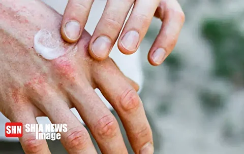 توصیه طب سنتی برای مراقبت از پوست در روزهای سرد